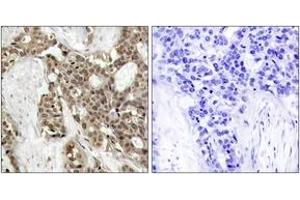 Immunohistochemistry analysis of paraffin-embedded human breast carcinoma, using p44/42 MAP Kinase (Phospho-Tyr204) Antibody. (ERK1/2 anticorps  (pTyr204))