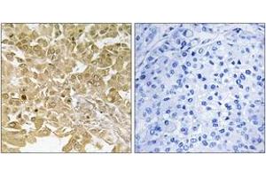 Immunohistochemistry analysis of paraffin-embedded human breast carcinoma tissue, using MEK1 (Ab-291) Antibody. (MEK1 anticorps  (AA 261-310))