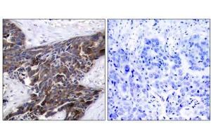 Immunohistochemical analysis of paraffin-embedded human breast carcinoma tissue using Connexin43 (phospho-Ser367) antibody (E011258). (Connexin 43/GJA1 anticorps  (pSer367))