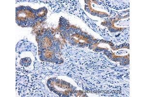 Immunohistochemistry of Human colon cancer using STAT5A Polyclonal Antibody at dilution of 1:25 (STAT5A anticorps)