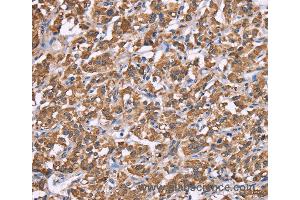 Immunohistochemistry of Human thyroid cancer using HSPE1 Polyclonal Antibody at dilution of 1:40 (HSPE1 anticorps)