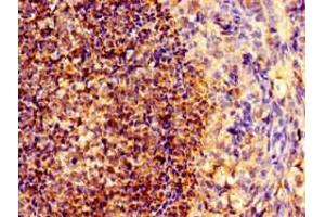 Immunohistochemistry of paraffin-embedded human ovarian cancer using ABIN7161294 at dilution of 1:100 (Notch1 anticorps  (AA 2428-2555))