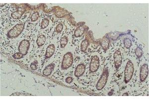 Immunohistochemistry of paraffin-embedded Human colon carcinoma tissue using HDAC1 Monoclonal Antibody at dilution of 1:200. (HDAC1 anticorps)