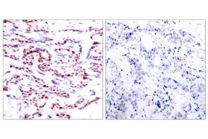 Immunohistochemical analysis of paraffin-embedded human breast carcinoma tissue using ATF-2 (phospho-Thr71 or 53) antibody (E011031). (ATF2 anticorps  (pThr53, pThr71))