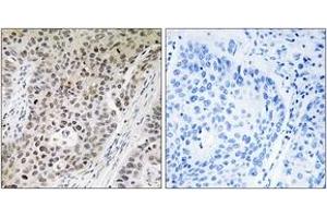 Immunohistochemistry analysis of paraffin-embedded human lung carcinoma tissue, using ZNF608 Antibody. (ZNF608 anticorps  (AA 1231-1280))