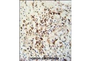 HAUS5 Antibody (N-term) (ABIN651423 and ABIN2840230) immunohistochemistry analysis in formalin fixed and paraffin embedded human colon carcinoma followed by peroxidase conjugation of the secondary antibody and DAB staining. (HAUS5 anticorps  (N-Term))