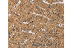 Immunohistochemistry of Human cervical cancer using KCNJ15 Polyclonal Antibody at dilution of 1:40 (KCNJ15 anticorps)