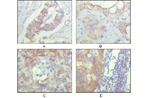 Immunohistochemical analysis of paraffin-embedded human ovary carcinoma (A), kidney carcinoma (B), lung carcinoma (C) and breast carcinoma (D), showing cytoplasmic and membrane localization with DAB staining using ALCAM mouse mAb. (CD166 anticorps)