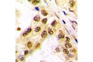Immunohistochemical analysis of c-Jun staining in human lung cancer formalin fixed paraffin embedded tissue section. (C-JUN anticorps)