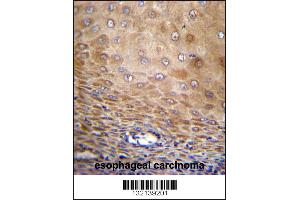 TMEM43 Antibody immunohistochemistry analysis in formalin fixed and paraffin embedded human esophageal carcinoma followed by peroxidase conjugation of the secondary antibody and DAB staining. (TMEM43 anticorps  (AA 195-223))