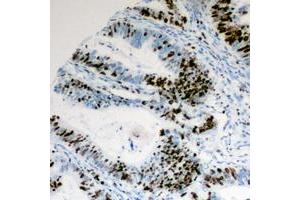 Immunohistochemical analysis of Cyclin E1 (pT395) staining in human colon cancer formalin fixed paraffin embedded tissue section. (Cyclin E1 anticorps  (C-Term, pSer395))