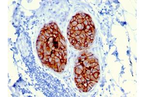 Formalin-fixed, paraffin-embedded human Breast Carcinoma stained with HER-2 Mouse Monoclonal Antibody (ERBB2/3080). (ErbB2/Her2 anticorps  (AA 311-462))