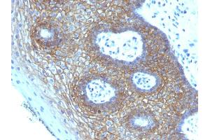 Formalin-fixed, paraffin-embedded human Cervical Squamous Cell Carcinoma stained with CD44v4 Mouse Monoclonal Antibody (CD44v4/1219) (CD44 anticorps)