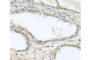 Immunohistochemistry of paraffin-embedded Human prostate using TNFRSF10A Polyclonal Antibody at dilution of 1:100 (40x lens). (TNFRSF10A anticorps)