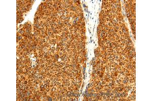 Immunohistochemistry of Human liver cancer using DIABLO Polyclonal Antibody at dilution of 1:50 (DIABLO anticorps)