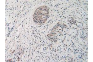 IHC-P analysis of Human Pancreas Cancer Tissue, with DAB staining. (MMP19 anticorps  (AA 98-508))