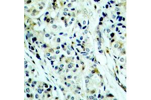 Immunohistochemistry of paraffin-embedded human breast carcinoma using Phospho-HDAC5-S498 antibody (ABIN2987596). (HDAC5 anticorps  (pSer498))