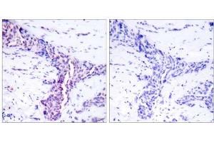 Immunohistochemical analysis of paraffin-embedded human breast carcinoma tissue using ATF-2 (Ab-73 or 55) antibody (E021032). (ATF2 anticorps)