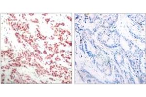 Immunohistochemistry analysis of paraffin-embedded human breast carcinoma, using NF-kappaB p100/p52 (Phospho-Ser865) Antibody. (NFKB2 anticorps  (pSer866))