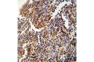 Immunohistochemistry analysis in formalin fixed and paraffin embedded human lung carcinoma reacted with HFM1 Antibody (C-term) followed which was peroxidase conjugated to the secondary antibody and followed by DAB staining. (HFM1 anticorps  (C-Term))