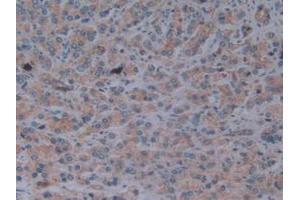 IHC-P analysis of Human Prostate Gland Cancer Tissue, with DAB staining. (Fibrillin 1 anticorps  (AA 246-389))