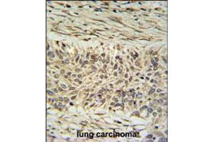 DDX23 Antibody IHC analysis in formalin fixed and paraffin embedded lung carcinoma followed by peroxidase conjugation of the secondary antibody and DAB staining. (DDX23 anticorps  (AA 248-277))