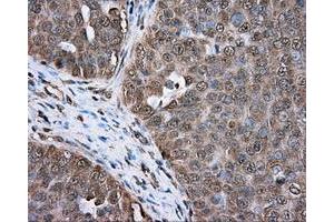 Immunohistochemical staining of paraffin-embedded colon tissue using anti-ERCC1 mouse monoclonal antibody. (ERCC1 anticorps)