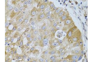 Immunohistochemistry of paraffin-embedded human breast cancer using HD antibody (ABIN6128014, ABIN6141689, ABIN6141690 and ABIN7101785) at dilution of 1:100 (40x lens). (HDAC8 anticorps  (AA 1-377))