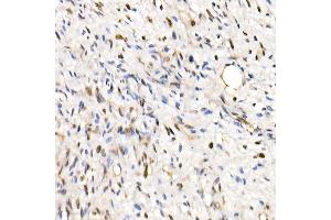Immunohistochemistry of paraffin-embedded Human epithelioid sarcoma (ini-1 deletion) using SM/SNF5 Rabbit pAb  at dilution of 1:250 (40x lens). (SMARCB1 anticorps  (AA 77-376))
