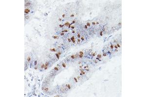 Immunohistochemistry of paraffin-embedded human colon carcinoma using RBPJK Rabbit mAb (ABIN1682563, ABIN3018511, ABIN3018512 and ABIN7101620) at dilution of 1:50 (40x lens). (RBPJ anticorps)