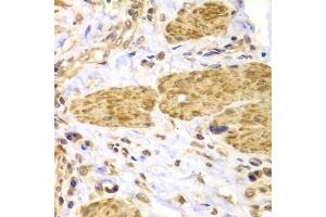 Immunohistochemistry of paraffin-embedded human gastric cancer using PTK2 antibody (ABIN5971141) at dilution of 1/100 (40x lens). (FAK anticorps)