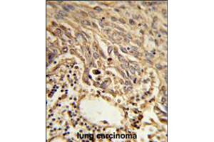 Formalin-fixed and paraffin-embedded human lung carcinoma reacted with EIF4A2 Antibody , which was peroxidase-conjugated to the secondary antibody, followed by DAB staining. (EIF4A2 anticorps  (C-Term))
