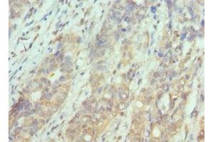 Immunohistochemistry of paraffin-embedded human endometrial cancer using ABIN7169126 at dilution of 1:100 (PAK1 anticorps  (AA 1-240))