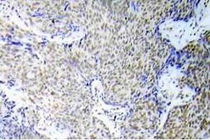 Immunohistochemistry (IHC) analyzes of p-GATA-1 antibody in paraffin-embedded human lung adenocarcinoma tissue. (GATA1 anticorps  (pSer310))