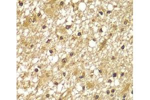 Immunohistochemistry of paraffin-embedded Human brain cancer using PIK3R3 Polyclonal Antibody at dilution of 1:100 (40x lens). (PIK3R3 anticorps)