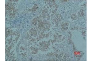 Immunohistochemistry (IHC) analysis of paraffin-embedded Human Lung Carcicnoma using Catenin-beta Monoclonal Antibody. (beta Catenin anticorps)