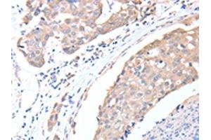 The image on the left is immunohistochemistry of paraffin-embedded Human breast cancer tissue using ABIN7128194(ACTL8 Antibody) at dilution 1/15, on the right is treated with fusion protein. (Actin-Like 8 anticorps)