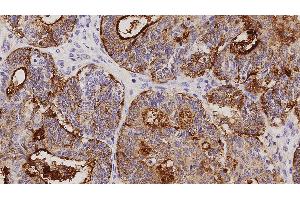 Human adenocarcinoma of endometrium: immunohistochemical staining on CA125. (MUC16 anticorps)