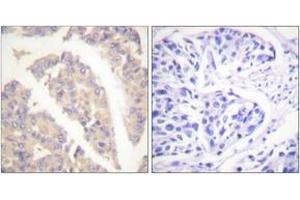 Immunohistochemistry analysis of paraffin-embedded human breast carcinoma tissue, using CBL (Ab-700) Antibody. (CBL anticorps  (AA 666-715))