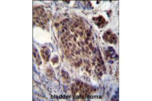 FRAT2 Antibody immunohistochemistry analysis in formalin fixed and paraffin embedded human bladder carcinoma followed by peroxidase conjugation of the secondary antibody and DAB staining. (FRAT2 anticorps  (C-Term))