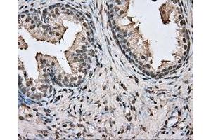 Immunohistochemical staining of paraffin-embedded Adenocarcinoma of colon tissue using anti-BSG mouse monoclonal antibody. (CD147 anticorps)