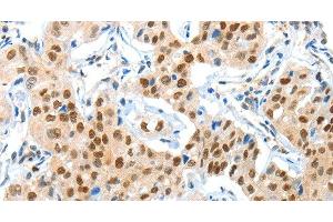 Immunohistochemistry of paraffin-embedded Human lung cancer using APPL1 Polyclonal Antibody at dilution of 1:70 (APPL1 anticorps)