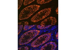 Immunofluorescence analysis of human colon carcinoma using GP Rabbit mAb (ABIN1682863, ABIN3017875, ABIN3017876 and ABIN7101532) at dilution of 1:100 (40x lens). (GPA33 anticorps)