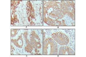 Immunohistochemical analysis of paraffin-embedded human breast carcinoma (A), hepatocarcinoma (B), stomach cancer (C) and colon cancer tissue (D), showing cytoplasmic location with DAB staining using CK18 antibody. (Cytokeratin 18 anticorps  (AA 391-483))