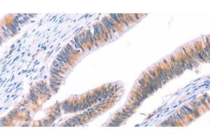 Immunohistochemistry of paraffin-embedded Human colon cancer tissue using VWF Polyclonal Antibody at dilution 1:50 (VWF anticorps)