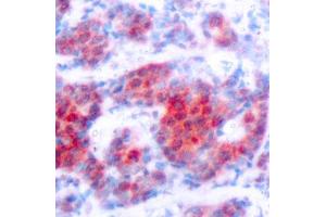 Immunohistochemistry of paraffin-embedded human breast carcinoma using Phospho-STAT4-Y693 antibody (ABIN2987407). (STAT4 anticorps  (pTyr693))