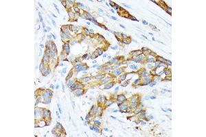 Immunohistochemistry of paraffin-embedded human esophageal cancer using STIP1 Rabbit mAb (ABIN1512566, ABIN3020619, ABIN3020620 and ABIN7101303) at dilution of 1:100 (40x lens). (STIP1 anticorps)