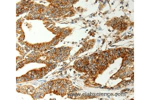 Immunohistochemistry of Human gastic cancer using COX7B Polyclonal Antibody at dilution of 1:70 (COX7B anticorps)