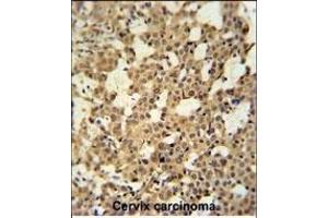 C Antibody (N-term) (ABIN650926 and ABIN2839997) immunohistochemistry analysis in formalin fixed and paraffin embedded human cervix carcinoma tissue followed by peroxidase conjugation of the secondary antibody and DAB staining. (CJ119 (AA 143-171), (N-Term) anticorps)