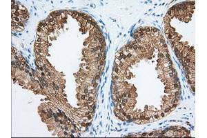 Immunohistochemical staining of paraffin-embedded Adenocarcinoma of Human colon tissue using anti-ACAT2 mouse monoclonal antibody. (ACAT2 anticorps)